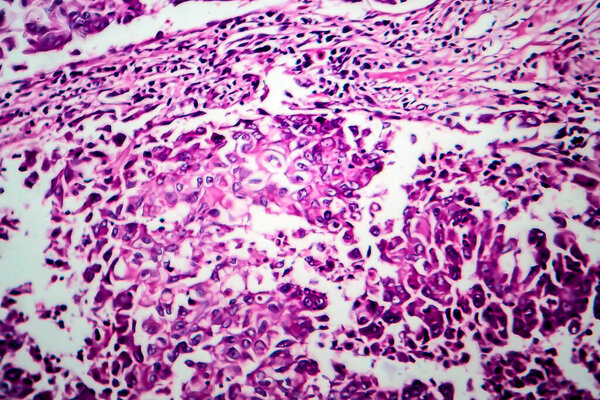 Breast ductal carcinoma, light micrograph, photo under microscope