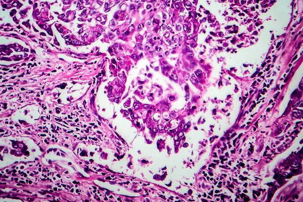 Breast ductal carcinoma, light micrograph, photo under microscope