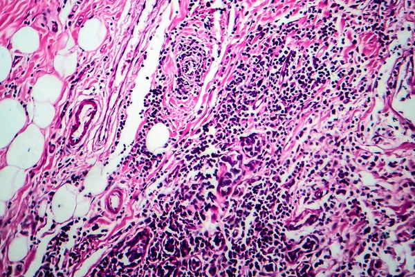 Carcinoma Ductal Mama Micrografía Ligera Foto Bajo Microscopio — Foto de Stock