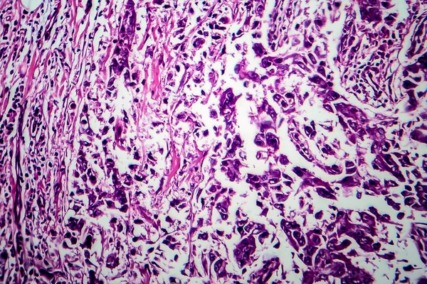 Carcinom Ductal Mamar Micrograf Deschis Fotografie Sub Microscop — Fotografie, imagine de stoc