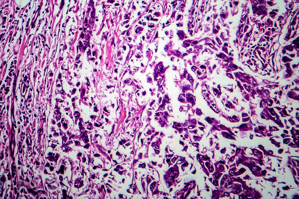 Breast ductal carcinoma, light micrograph, photo under microscope