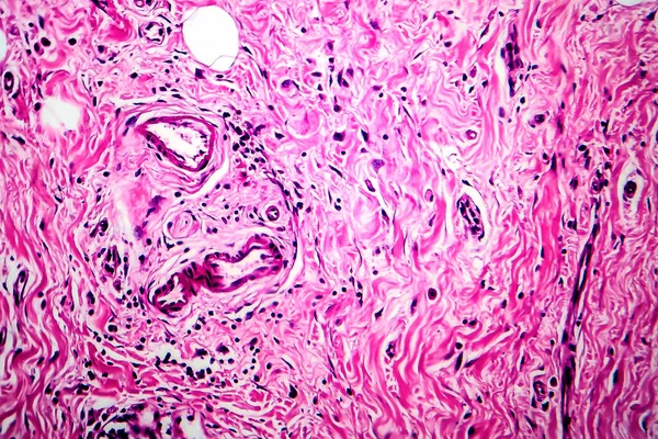 Rak Kanału Piersiowego Mikrograf Świetlny Zdjęcie Pod Mikroskopem — Zdjęcie stockowe