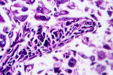 Göğüs kanseri, hafif mikrograf, mikroskop altında fotoğraf.