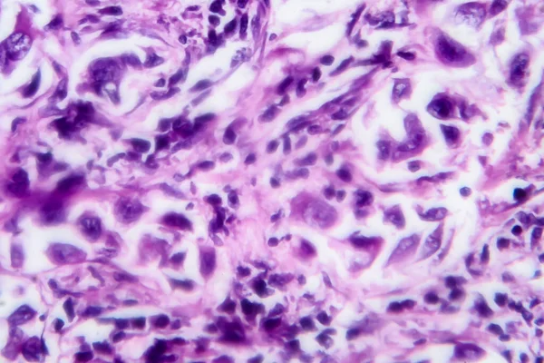 Карцинома Молочної Залози Легкий Мікрограф Фото Під Мікроскопом — стокове фото