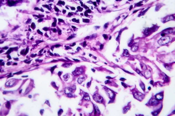 Carcinoma Ductal Mama Micrografía Ligera Foto Bajo Microscopio — Foto de Stock