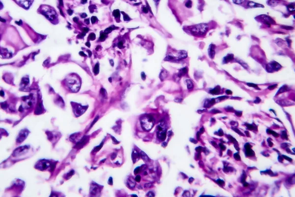 Karcinom Prsu Lehký Mikrograf Fotografie Pod Mikroskopem — Stock fotografie