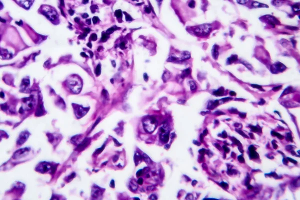 Carcinoma Duttale Mammario Microscopio Leggero Foto Microscopio — Foto Stock