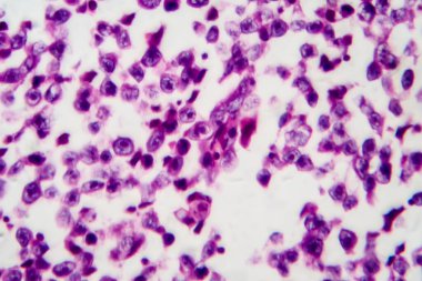 Testis semineri, ışık mikrografı, mikroskop altında fotoğraf. Testisin en yaygın germ hücresi tümörü.