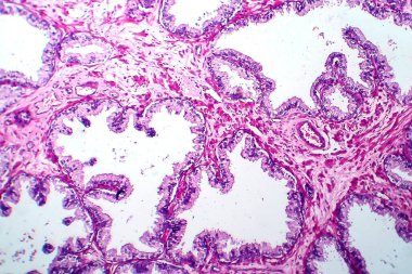 Prostat kanseri, ışık mikrografı, mikroskop altında fotoğraf.