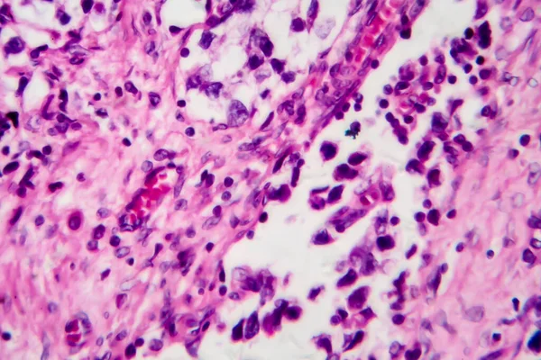 Seminoma Testicular Micrografía Ligera Foto Bajo Microscopio Tumor Células Germinativas — Foto de Stock