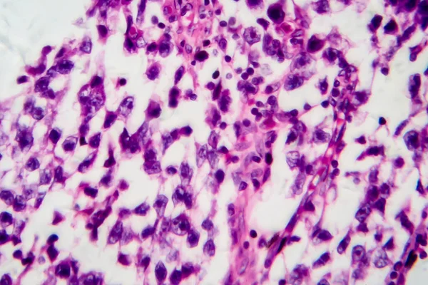 Seminoma Testicular Micrografia Luz Foto Sob Microscópio Tumor Células Germinativas — Fotografia de Stock