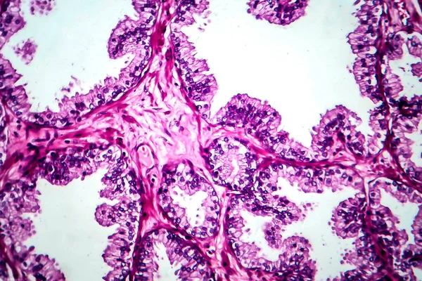 前立腺癌 光マイクログラフ 顕微鏡下の写真 — ストック写真
