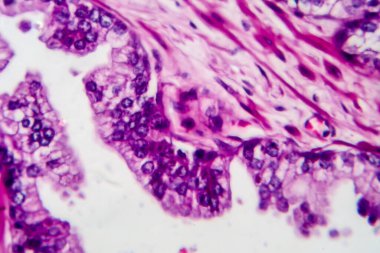 Prostat kanseri, ışık mikrografı, mikroskop altında fotoğraf.