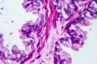 Prostat kanseri, ışık mikrografı, mikroskop altında fotoğraf.