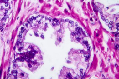 Prostat kanseri, ışık mikrografı, mikroskop altında fotoğraf.