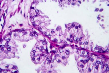 Prostat kanseri, ışık mikrografı, mikroskop altında fotoğraf.