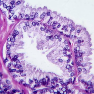 Prostat kanseri, ışık mikrografı, mikroskop altında fotoğraf.