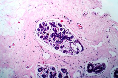 Göğüs kanseri, ışık mikrografı, mikroskop altında fotoğraf.