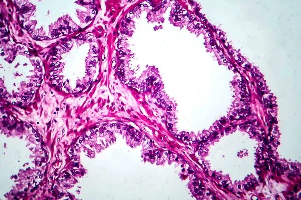 Cáncer Próstata Micrografía Ligera Foto Bajo Microscopio —  Fotos de Stock