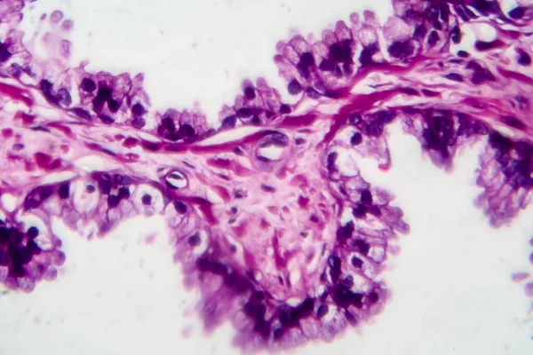 Cáncer Próstata Micrografía Ligera Foto Bajo Microscopio —  Fotos de Stock