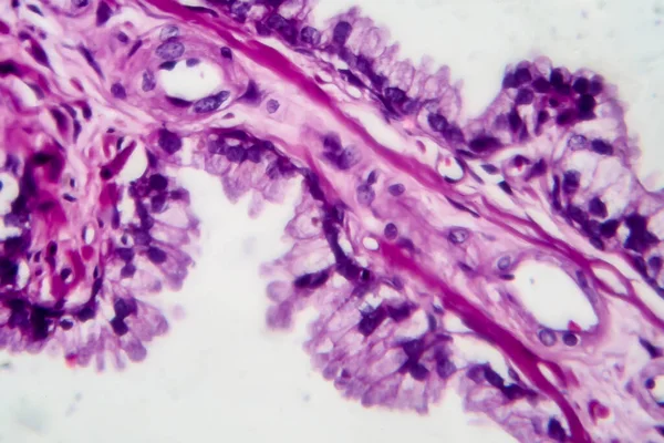 Rakovina Prostaty Světelný Mikrograf Fotografie Pod Mikroskopem — Stock fotografie