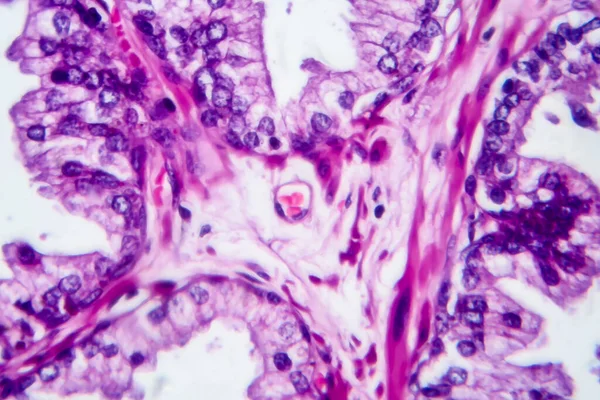 Cancer Prostate Micrographie Photonique Photo Microscope — Photo