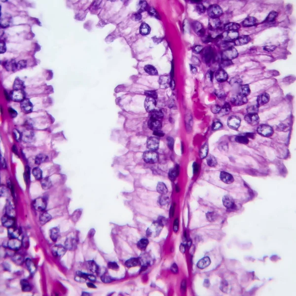 Câncer Próstata Micrografia Luz Foto Sob Microscópio — Fotografia de Stock