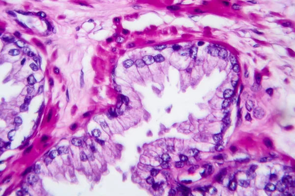 Prostaatkanker Lichtmicrograaf Foto Onder Microscoop — Stockfoto