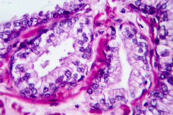 Cáncer Próstata Micrografía Ligera Foto Bajo Microscopio — Foto de Stock