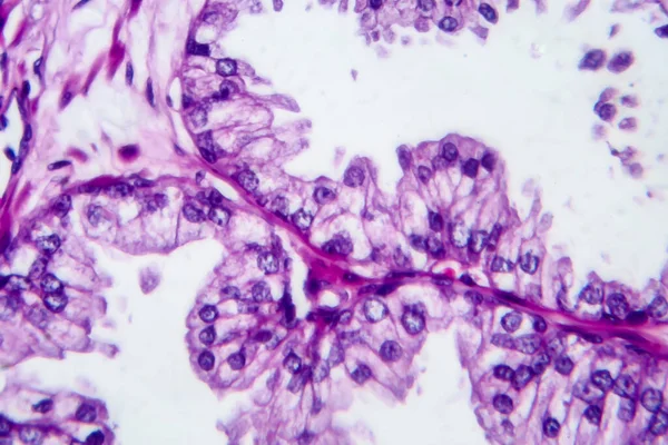 Prostat kanseri, ışık mikrografı, mikroskop altında fotoğraf.