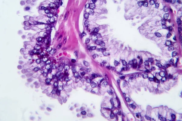 Cancer Prostate Micrographie Photonique Photo Microscope — Photo