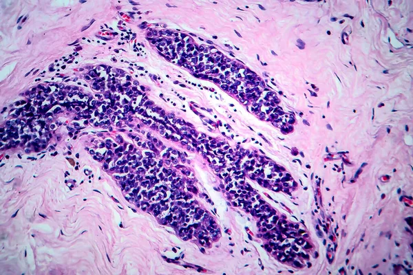 유방암 마이크로 그래프 현미경으로 — 스톡 사진