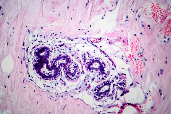 乳腺癌 显微镜下照片 — 图库照片