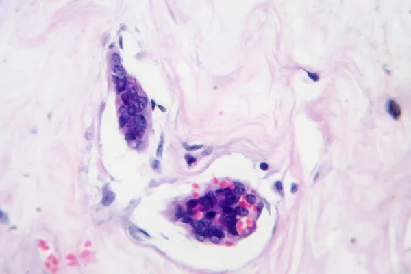 유방암 마이크로 그래프 현미경으로 — 스톡 사진