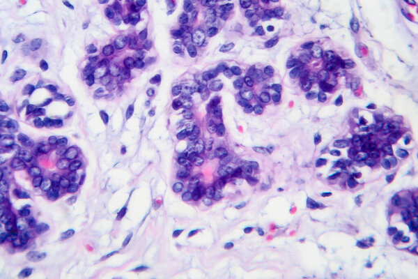 Breast cancer, light micrograph, photo under microscope