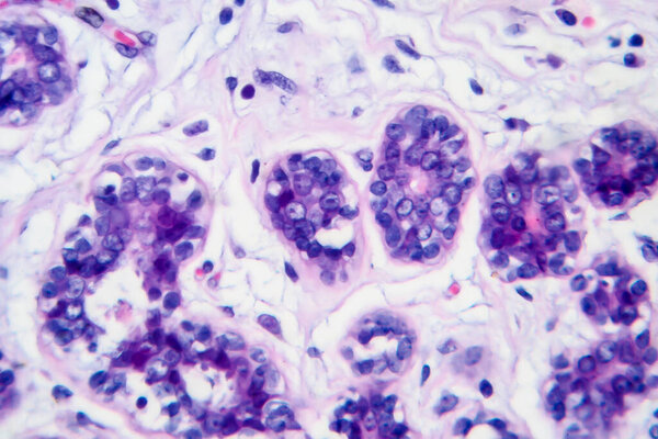 Breast cancer, light micrograph, photo under microscope