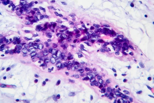 Cancer Sein Micrographie Photonique Photo Microscope — Photo