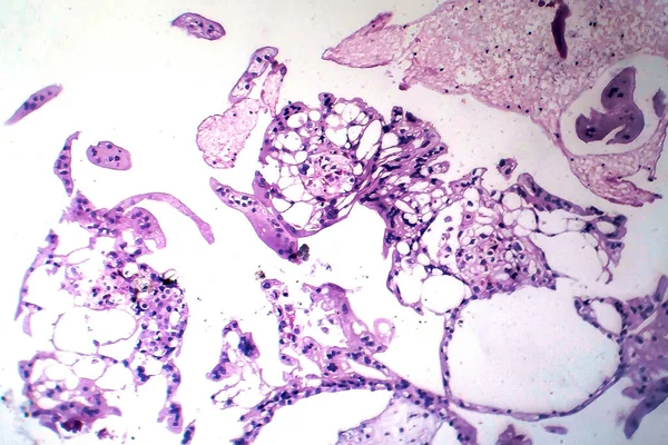 Hydatiformní Krtek Světelný Mikrograf Gestační Trofoblastické Onemocnění Abnormálními Choriovými Villi — Stock fotografie