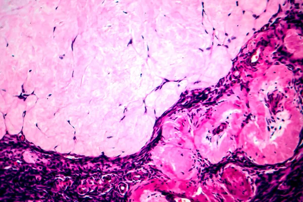 Ovariell Follikulär Cysta Ljusmikrograf Foto Mikroskop — Stockfoto