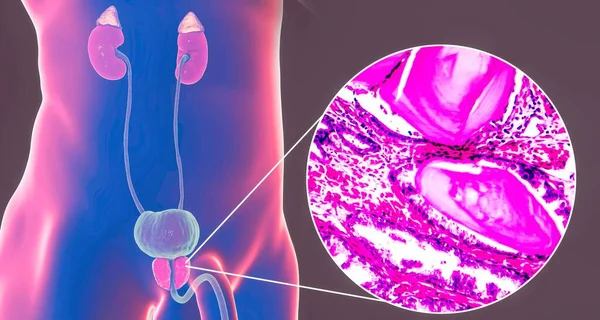 良性前列腺增生 显示前列腺肿大的三维图像和显示腺体扩张 腺体上皮细胞包裹 囊性扩张的光镜 — 图库照片