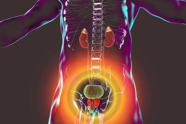 Hiperplasia Prostática Benigna Ilustración Que Muestra Agrandamiento Glándula Prostática — Foto de Stock