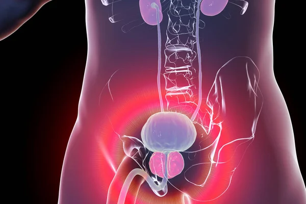 Benign Prostatic Hyperplasia Illustration Showing Enlarged Prostate Gland — Stock Photo, Image