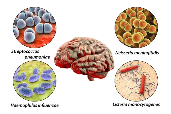 Etiology Bacterial Meningitis Illustration Neisseria Meningitidis Streptococcus Pneumoniae Haemophilus Influenzae — Stock Photo, Image