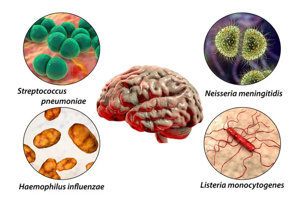Etiología Meningitis Bacteriana Ilustración Neisseria Meningitidis Streptococcus Pneumoniae Haemophilus Influenzae — Foto de Stock