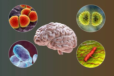 Bakteriyel menenjit etiyolojisi, 3 boyutlu illüstrasyon. Neisseria meningitidis, Streptococcus pneumoniae, Haemophilus influenzae ve Listeria monocytogenes bakterileri