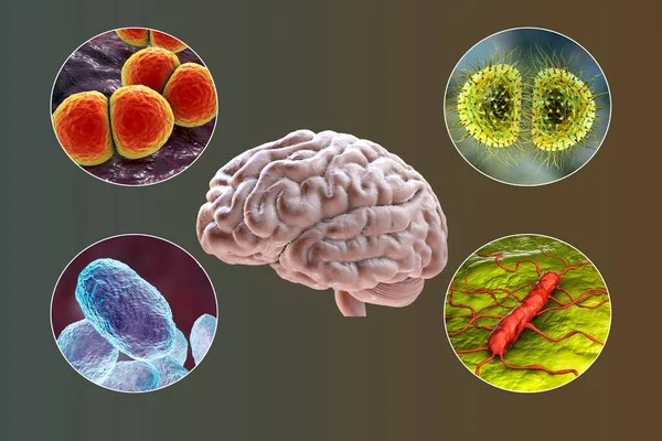 Etiologie Bakteriální Meningitidy Ilustrace Neisseria Meningitidis Streptococcus Pneumoniae Haemophilus Influenzae — Stock fotografie