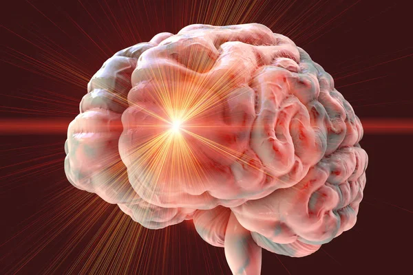 Beyin Felci Baş Ağrısı Migren Diğer Beyin Hastalıkları Kavramsal Boyutlu — Stok fotoğraf