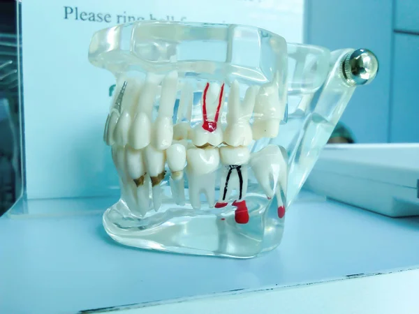 Modelo de dentes raiz cura ou reparação e preenchimento de dentes — Fotografia de Stock