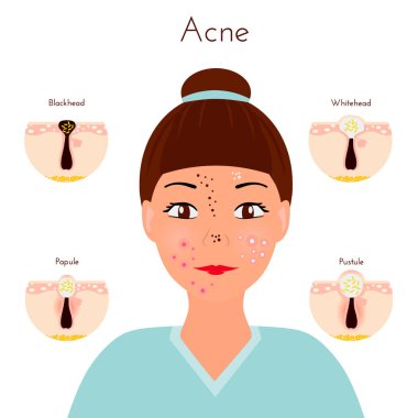 Skin problems. Girl closse up face with different types of acne pimples. Facial treatments and problems vector illustration. Whiteheads and Blackheads, Papules and Pustules, stages of development clipart