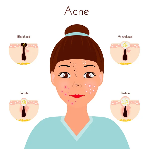 Problemas de piel. Chica cerrar la cara con diferentes tipos de granos de acné. Tratamientos faciales y problemas de ilustración vectorial. Whiteheads y Blackheads, pápulas y pústulas, etapas de desarrollo — Vector de stock